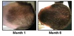 Is a widow's peak a sign of balding? Widow S Peak Warning Of Hair Loss In Men