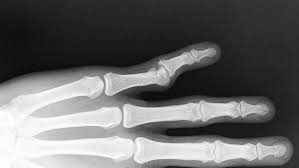 Image result for Interphalangeal Dislocation