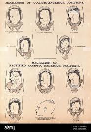 Image result for Manual Rotation in Occipitoposterior Presentation