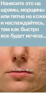 как избавиться от шрамов на ногах в домашних условиях Nanesite Eto Na Shramy Morshiny Ili Pyatna Na Kozhe I Naslazhdajtes Tem Kak Bystro Vse Budet Ischezat Dazhe Vrachi Sh V 2020 G Chistoe Lico Tovary Dlya Zdorovya Podtyazhka Kozhi