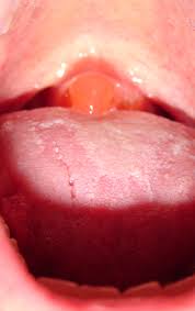 Image result for Uvulitis