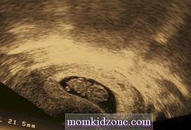 Cara menggugurkan kandungan yang pertama adalah dengan menggunakan obat aborsi. 8 Minggu Ultrasound Mengandung Prosedur Keabnormalan Dan Banyak Lagi Kehamilan 2021
