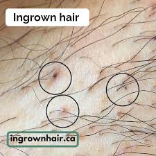 Apply a clean cloth to avoid irritation after shaving. Pin On Ingrownhair Ca