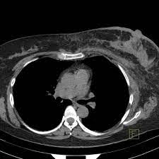 Feline cancer initially manifests as a lump or bump on any parts of the body. Breast Cancer Ct Appearances Radiology Case Radiopaedia Org