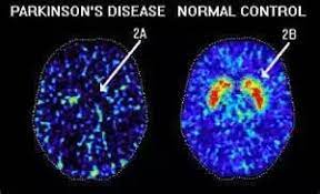 Is There A Way To Measure Dopamine Levels? - Quora