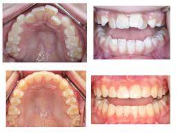 The most effective and popularly the most effective and popularly used method to straighten teeth in this way is to use dental braces; Is Fast Teeth Straightening Possible With Invisalign Dr Jacquie