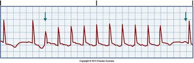 Paroxysmal supraventricular tachycardia (psvt) is a type of irregular heart rhythm or heart arrhythmia where an individual's heart rate becomes excessively fast, starting and stopping suddenly. Pin On Health Fitness