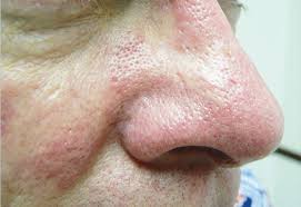 Le saignement de nez, même s'il est souvent spectaculaire, est rarement grave. Traitement Laser Des Lesions Vasculaires Du Visage Clinique Claude Bernard Ermont Val D Oise 95