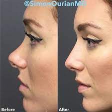 O preço de lipoaspiração na barriga inclui lipo. Wie Viel Kostet Eine Nasenkorrektur Kosten Eine Kosten Kostet Nasenkorrektur Viel Wie Nonsurgical Nose Job Nose Job Rhinoplasty Nose Jobs