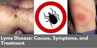 Lyme Disease Symptoms Causes And Treatment