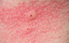 We did not find results for: 7 Green Ways To Treat Spider Bites