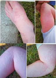 Image result for Exercise-Induced Anaphylaxis