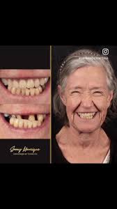 La felicidad de una persona se refleja en sus ojos, en su carisma pero  también en su salud. Prótesis total superior posterior a exodoncias.  #drsamymanrique #odontologiaentendencia #tendencia #viral ...
