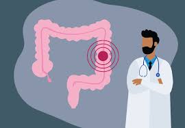 Major part of large intestine, the final section of the digestive system. How To Prevent Colorectal Cancer Cleveland Clinic