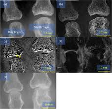 Image result for XRay Changes in Rheumatic Conditions