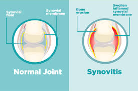Joint pain is a common complaint. What Is Synovitis And How Does It Affect Arthritis Creakyjoints