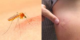 Image result for mosquito bite