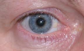 Was könnte ich dagegen tun, denn es juckt aber schmerzt zugleich. Bindehauterkrankungen Auge Online