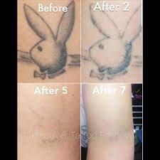 Lasers are the most popular choice when it comes to tattoo removal in vancouver. We Offer Laser Tattoo Removal At Gastown Tattoo Parlour Facebook