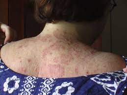635 Msg Boosters Ribo Rash Ribonucleotides 627 631 Food Intolerance Network