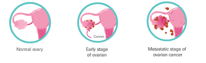 Find clinical trials for ovarian cancer. Ovarian Cancer