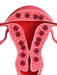 However, it is most often present in women over 40 years old or those who have had more than 3 children. Myometrium Princeton Fertility Blog Dr Seth Derman Princeton Ivf