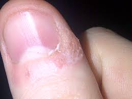 Check spelling or type a new query. Periungual Warts Description With Photos Causes Symptoms Removal Options And Recommendations Of Doctors