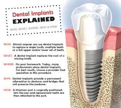 Dental Implants Explained Teeth Implants Dental Implants Tooth Implant Cost