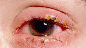 I Have Red Eyes Adenovirus Conjunctivitis Floaters Eye Blepharitis Eye Floaters Causes