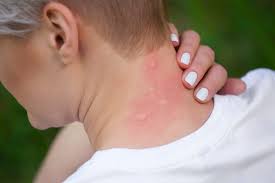 Rash That Looks Like Mosquito Bites Lovetoknow