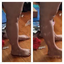 Hyperextended knees are often a problem in trikonasana, for several reasons. Neutral And Hyperextended Knees Ehlersdanlos