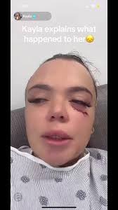 What Happened Kayla Mcneil Head Kandy