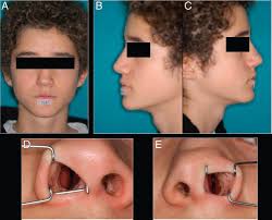 Nasal Growth after Pediatric Septoplasty at Long-term Follow-up