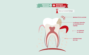 Depuis, il y a fait plus d'un million de morts dans le monde. Comprendre La Maladie Des Gencives Ameli Fr Assure