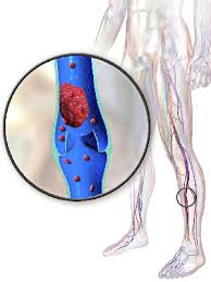 Related online courses on physioplus. Vein Thrombosis Treatment In Clinics In Germany Austria Switzerland
