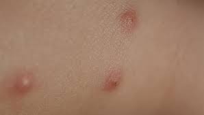 Identifying Common Insect Bites And Stings Sentinel Blog