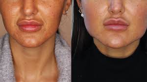 We only use premium iso and fda approved products to bring the latest & safest technology to our clinics. Lockdown Lip Fillers Gone Wrong My Lips Went Black Bbc News