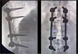 Image result for Chance Fracture