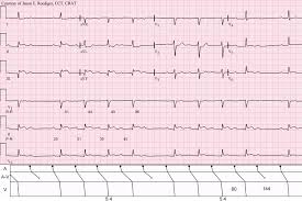 Blocul atrioventricular de grad iii congenital este rar (1 caz la 20.000 de nasteri), insa mortalitatea ajunge la 20%. Innere Medizin Kk Avblock Wikibooks Sammlung Freier Lehr Sach Und Fachbucher