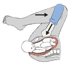 Image result for Shoulder Presentation