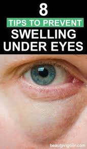8 Tips To Prevent Swelling Under Eye Undereye Prevent Swelling Eye Care