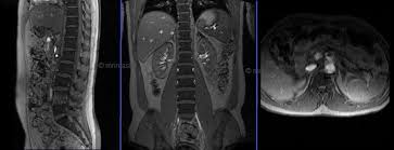 Lumbar Lumbosacral Spine Mri Planning And Protocols Indications For Mri Lumbar Spine Scan Mri Lumbar Spines