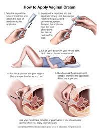 Active ingredient miconazole nitrate 2%; Miconazole Vaginal Tufts Medical Center Community Care