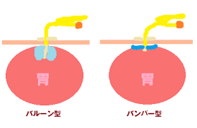 「胃瘻」の画像検索結果