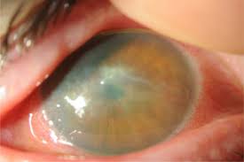 Image result for Keratitis