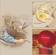 Le dimensioni possono variare da pochi millimetri a lesioni definite giganti, di diametri maggiori di 2.5 cm. Rivoluzionario Monitoraggio Wireless Degli Aneurismi Intracranici Trattati Per Via Endovascolare Ingegneriabiomedica Org