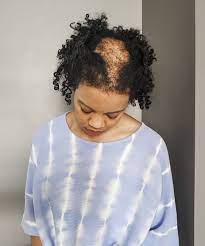 The body makes higher levels of androgens than expected. Scarring Alopecia Chronic Hair Loss Is Prevalent Amongst Black Women Nola Johnson Shares How Her Hair Loss Journey Led Her To Homeopathic Healthcare Melaninass Com