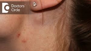 Posterior cervical lymph nodes pain. Causes Of Painful Lymph Nodes In Neck Dr Satish Babu K Youtube