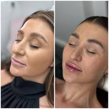 Ready for Christmas! 😍 This beautiful patient of mine was so kind to let  me share her results! ❤️ This first pic was taken back in February of this  year, and the