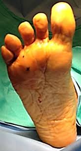 Radiofrequency Ablation For The Treatment Of Painful Neuroma The Journal Of Foot And Ankle Surgery